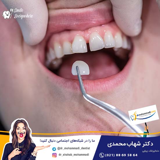 مقایسه ونیرهای دندانی: کامپوزیت بهتر است یا لمینیت؟ - کلینیک دندانپزشکی دکتر شهاب محمدی